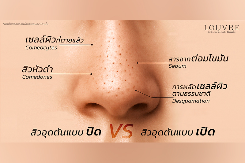 สิวอุดตันแบบปิด VS สิวอุดตันแบบเปิด ต่างกัน?