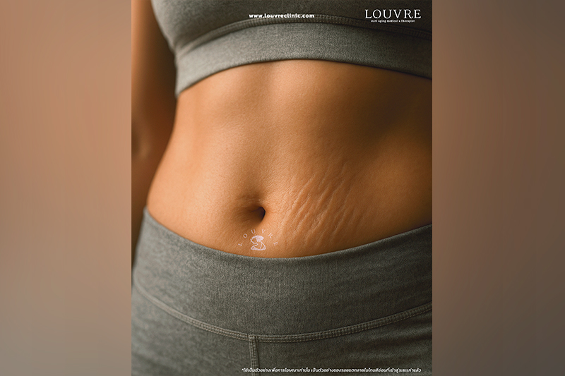 รอยแตกลาย (Stretch Marks) ไม่ได้เหมือนกันทุกคน